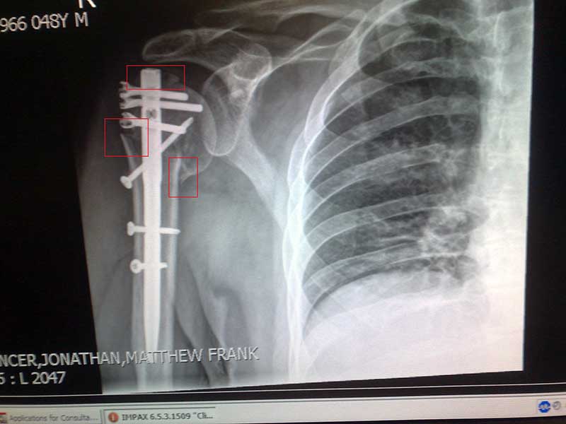 Displacement-of-humeral-head.jpg